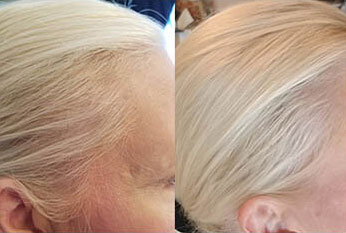 Thinning Hairlines in Women: Causes and Solutions